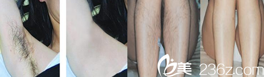 屬于蚌埠國色整形美容醫(yī)院的腋下脫毛+小腿脫毛<span style=