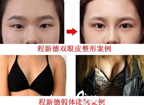 蚌埠國(guó)色整形美容醫(yī)院怎么樣？看蚌埠國(guó)色程新德雙眼皮整形案例+假體隆胸案例效果展示