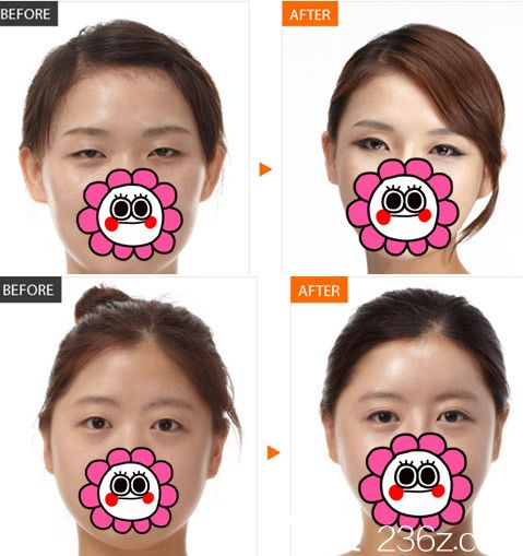 蚌埠國色整形美容醫(yī)院朱寶玉做眼部整形案例前后對比圖 蚌埠國色整形美容醫(yī)院朱寶玉做眼部整形案例前后對比圖