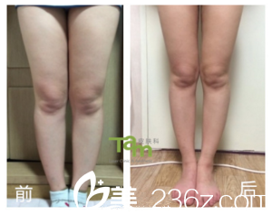 瘦腿前后效果對比
