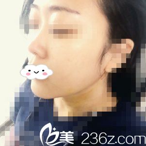 手術(shù)后第八天 手術(shù)后第八天