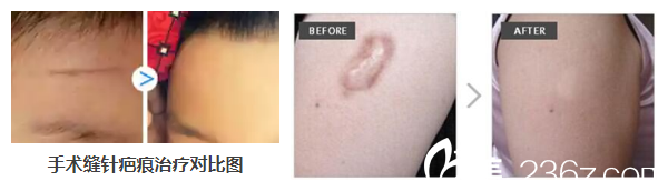 <!--<i data=20240703-sp></i>-->醫(yī)生激光祛疤案例 <!--<i data=20240703-sp></i>-->醫(yī)生激光祛疤案例