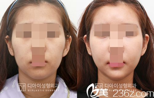 DI整形醫(yī)院面部輪廓案例