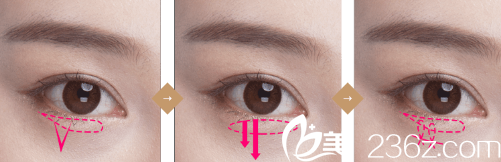 DI整形醫(yī)院雙眼皮示意圖