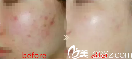 皮膚管理真人前后對比 皮膚管理真人前后對比