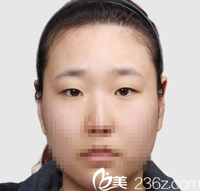 我讓聊城韓美整形倪景輝醫(yī)生做了全切雙眼皮手術(shù)后，改變了我的小眼睛