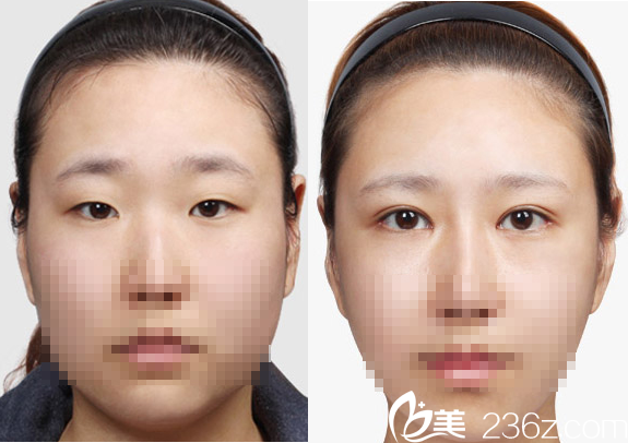 聊城韓美雙眼皮切開術(shù)前術(shù)后對比圖 聊城韓美雙眼皮切開術(shù)前術(shù)后對比圖