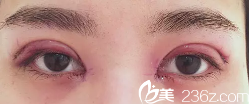 術后天腫脹期效果圖 術后天腫脹期效果圖