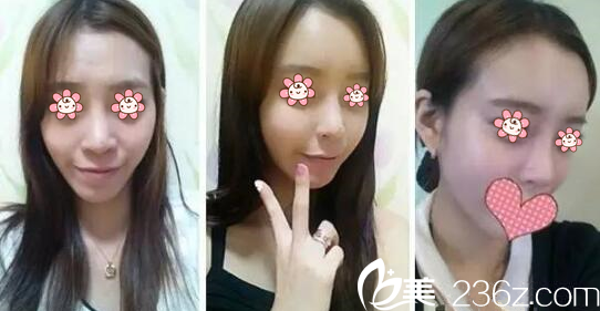 宋寅洙院長面部脂肪填充案例 宋寅洙院長面部脂肪填充案例