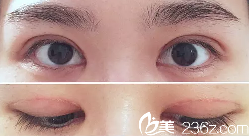 術后一個月效果圖 術后一個月效果圖