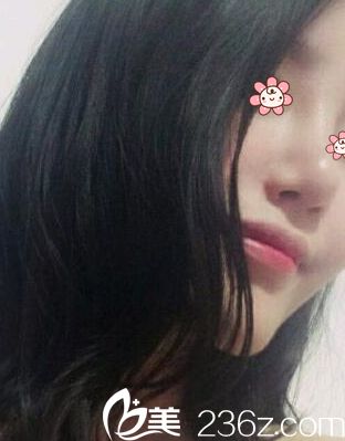 感覺一個(gè)月后鼻子越來越好看~