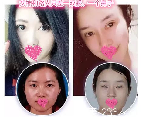 安慶維多利亞端木義勇做雙眼皮和隆鼻怎么樣？看端木義勇全切雙眼皮+假體隆鼻案例對比圖