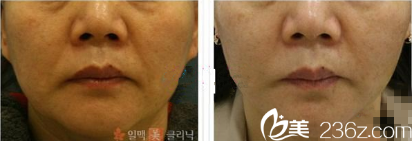 韓國一脈美面部提升去皺手術(shù) 韓國一脈美面部提升去皺手術(shù)
