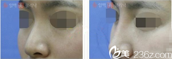 韓國一脈美注射隆鼻 韓國一脈美注射隆鼻