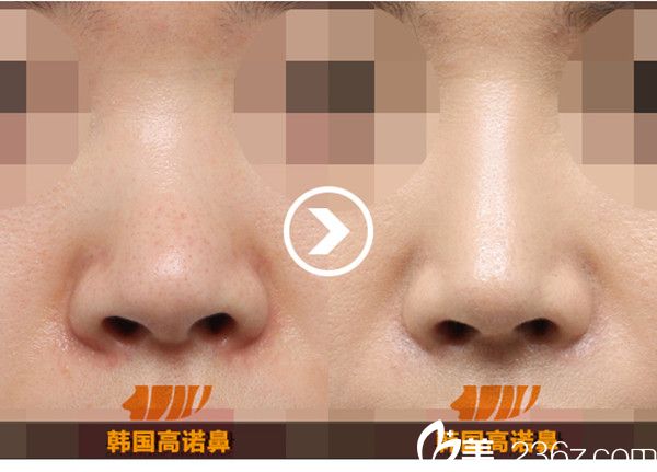 韓國(guó)高諾鼻CONOPI整形外科醫(yī)院隆鼻案例