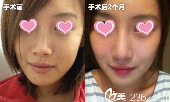 韓國(guó)高諾鼻CONOPI整形外科醫(yī)院隆鼻安利了