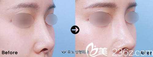 鼻整形前后效果對(duì)比