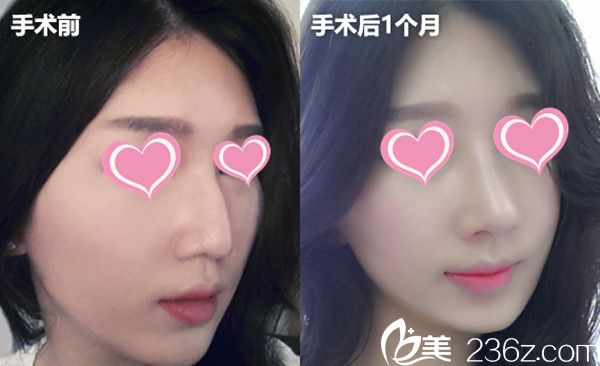 鄭太英院長隆鼻手術(shù)真人案例