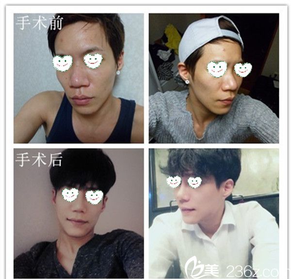 韓國高諾鼻CONOPI整形外科醫(yī)院案例 韓國高諾鼻CONOPI整形外科醫(yī)院案例