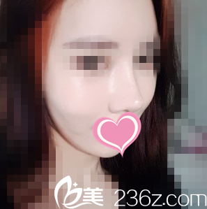 沒想到找韓國朱諾整形醫(yī)院任榮旻做鼻綜合術(shù)一個(gè)月后變化竟然這么大！