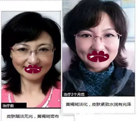 彭衛(wèi)東祛斑美膚案例前后效果對(duì)比圖