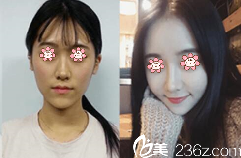 白衡翼院長自體脂肪面部填充案例 白衡翼院長自體脂肪面部填充案例