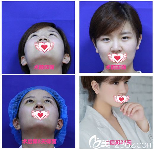 安徽維多利亞衛(wèi)愛俠膨體假體隆鼻鼻綜合恢復(fù)過程對比圖