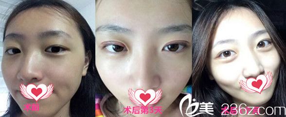 何賢清做雙眼皮怎么樣呢？看何賢清割雙眼皮整形案例效果展示