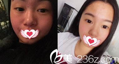 去安徽維多利亞整形外科醫(yī)院找吳麗麗醫(yī)生做全切雙眼皮案例前后對(duì)比照