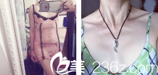 胸部術(shù)前圖 胸部術(shù)前圖