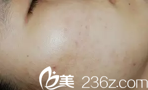 敘述大連美女在韓國海德仁皮膚醫(yī)院的激光祛痘之行！