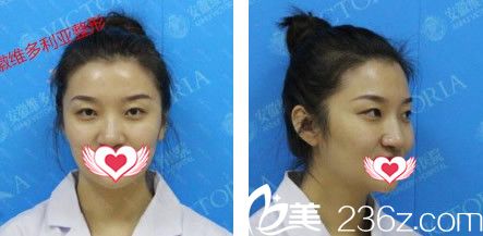 沒有去安徽維多利亞整形外科醫(yī)院做雙眼皮之前照片 沒有去安徽維多利亞整形外科醫(yī)院做雙眼皮之前照片