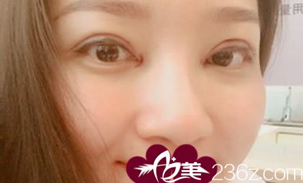 去安徽維多利亞整形美容醫(yī)院做全切雙眼皮手術(shù)天 去安徽維多利亞整形美容醫(yī)院做全切雙眼皮手術(shù)天