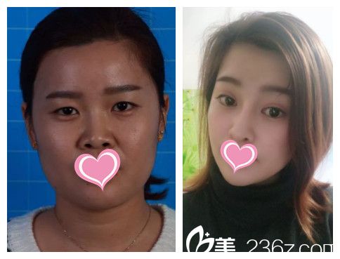 郭東超做雙眼皮案例 郭東超做雙眼皮案例