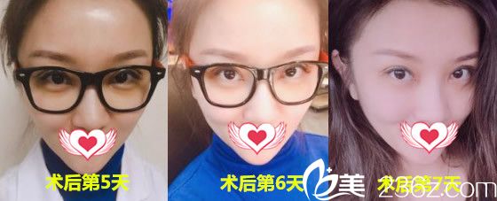 安徽維多利亞整形美容醫(yī)院徐和林全切法雙眼皮術(shù)后第5~6天恢復(fù)過程圖 安徽維多利亞整形美容醫(yī)院徐和林全切法雙眼皮術(shù)后第5~6天恢復(fù)過程圖