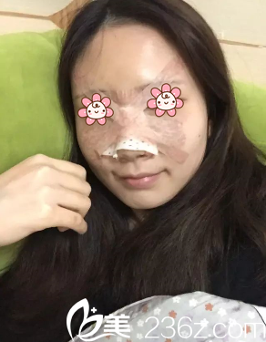 術(shù)后第二天