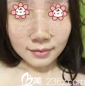 張裕珍院長給我做完五天咯