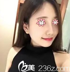 去韓國普瑞美整形約張裕珍手術才知道做個肋軟骨隆鼻根本不算啥