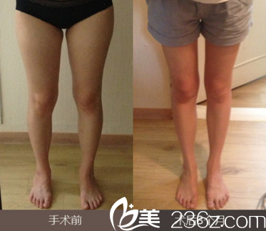 激光溶脂瘦腿前后<span style= 激光溶脂瘦腿前后<span style=