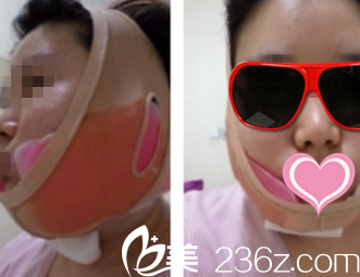 術(shù)后天 術(shù)后天