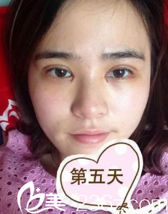 自述在漢中華美奧萊整形醫(yī)院找廖桂雷主任做全切雙眼皮過程