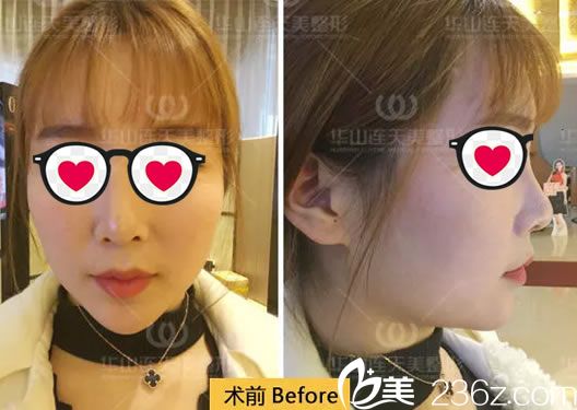 注射玻尿酸和瘦臉前的照片 注射玻尿酸和瘦臉前的照片