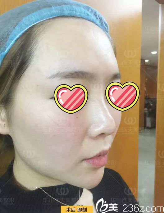 注射玻尿酸填充蘋果肌和太陽(yáng)穴即刻<span style= 注射玻尿酸填充蘋果肌和太陽(yáng)穴即刻<span style=