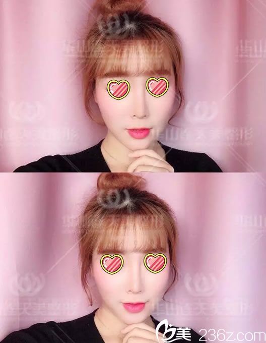 連天美注射玻尿酸第7天恢復(fù)照 連天美注射玻尿酸第7天恢復(fù)照