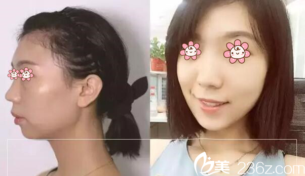 河相旭院長(zhǎng)瘦臉除皺瘦臉案例 河相旭院長(zhǎng)瘦臉除皺瘦臉案例