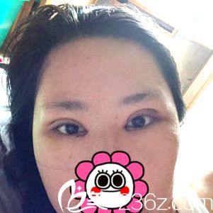 術(shù)后三天效果 術(shù)后三天效果