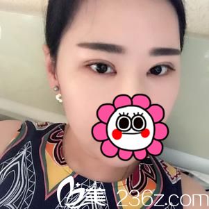 想看宜昌伊萊美整形案例？那醫(yī)生劉志兵為我做的切開雙眼皮你喜歡不