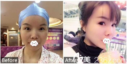 廣州美萊雷濤主任脂肪填充和隆鼻案例 廣州美萊雷濤主任脂肪填充和隆鼻案例