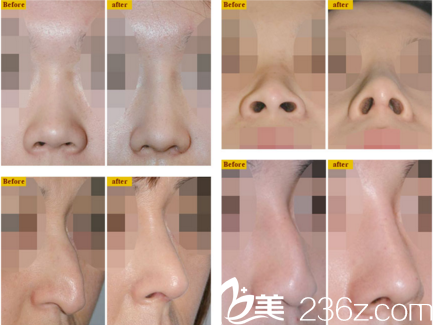 鄭載用鼻部整形真人案例展示