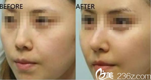 謝常禮鼻綜合隆鼻案例對(duì)比照 謝常禮鼻綜合隆鼻案例對(duì)比照